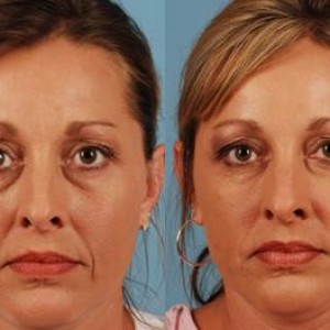 RadiessePlus Filler in Oakland County MI | FACE Beauty Science