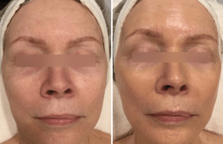 Cryo-Quantum Treatment in Oakland County MI | FACE Beauty Science