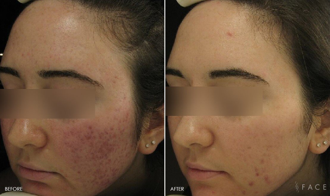 Acne Treatments in Oakland County MI | FACE Beauty Science