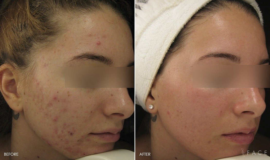 Acne Treatments in Oakland County MI | FACE Beauty Science