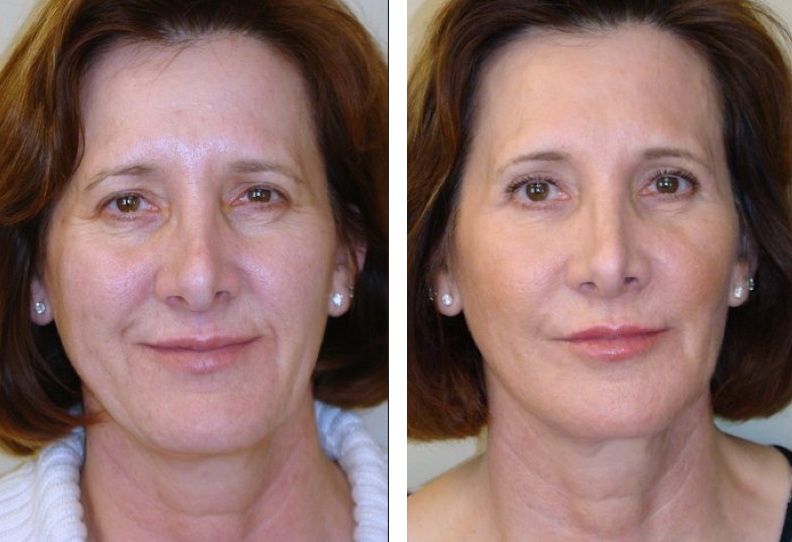 active fx laser resurfacing near me