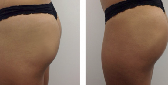 NON-SURGICAL BUTT-LIFT WITH SCULPTRA AND RADIESSE, Before & After