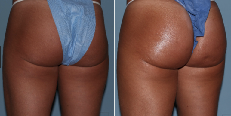 Non-Surgical Brazilian Butt Lift in Oakland County MI | FACE Beauty Science