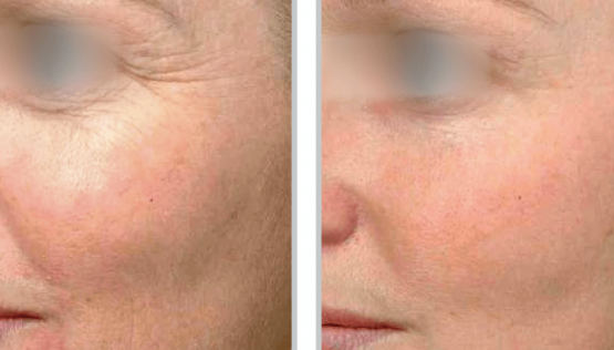 Contour TRL™ Before & After Oakland County MI | FACE Beauty Science