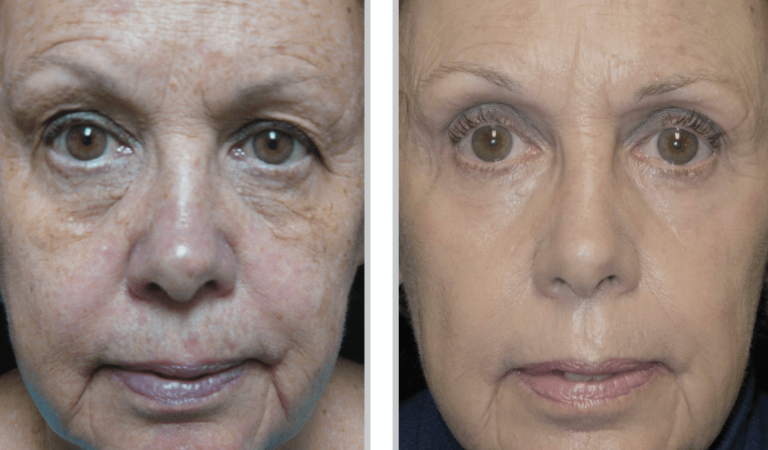 Contour TRL™ Before & After Oakland County MI | FACE Beauty Science
