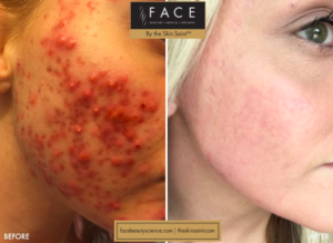 Cystic Acne Treatments in Oakland County MI | FACE Beauty Science