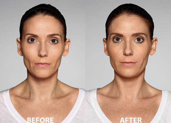 Restylane® Defyne Injectable Filler in Oakland County MI | FACE Beauty Science