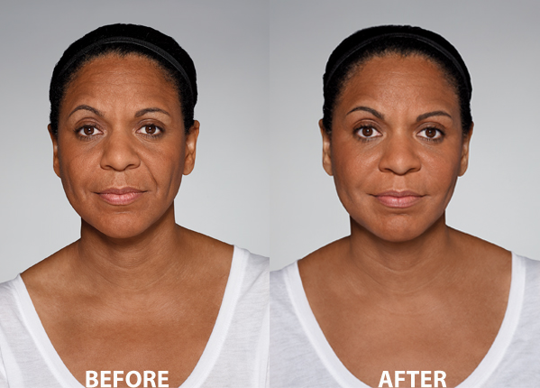 Restylane® Defyne Injectable Filler in Oakland County MI | FACE Beauty Science