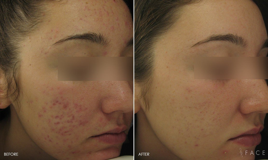 Acne Treatments in Oakland County MI | FACE Beauty Science