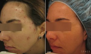 Acne Treatments in Oakland County MI | FACE Beauty Science