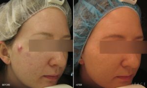 Acne Treatments in Oakland County MI | FACE Beauty Science