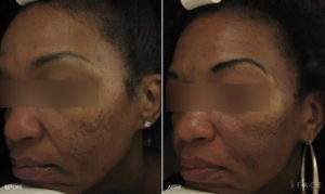 Acne Treatments in Oakland County MI | FACE Beauty Science