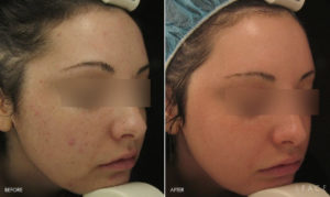 Acne Treatments in Oakland County MI | FACE Beauty Science