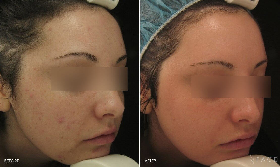 Acne Treatments in Oakland County MI | FACE Beauty Science