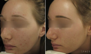 Acne Treatments in Oakland County MI | FACE Beauty Science