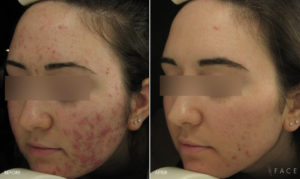 Acne Treatments in Oakland County MI | FACE Beauty Science