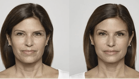 MicroTox Aquagold Facial Oakland County MI | FACE Beauty Science