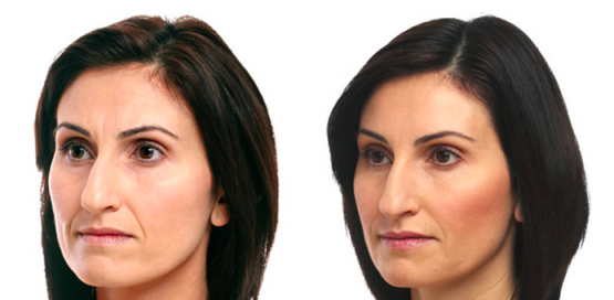 Liquid Facelift Treatments in Oakland County MI | FACE Beauty Science