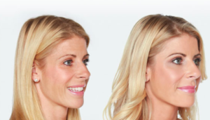 Liquid Facelift Treatments in Oakland County MI | FACE Beauty Science