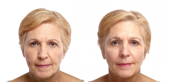 Liquid Facelift Treatments in Oakland County MI | FACE Beauty Science