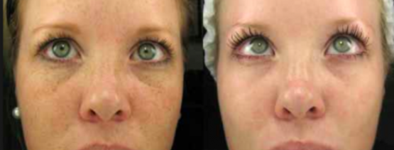 Limelight Treatments Oakland County MI | FACE Beauty Science