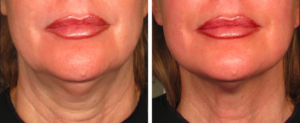 Ultherapy® Treatments in Oakland County MI | FACE Beauty Science