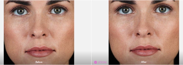 JUVÉDERM VOLBELLA® XC Injectable Filler in Oakland County MI | FACE Beauty Science