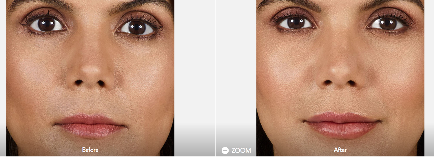 Juvederm Volbella Birmingham Lip Line Filler Oakland County MI Face Beauty Science