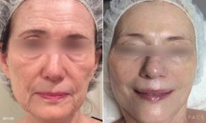 Anti-Aging Results Oakland County MI | FACE Beauty Science