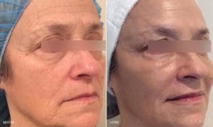 Anti-Aging Results Oakland County MI | FACE Beauty Science