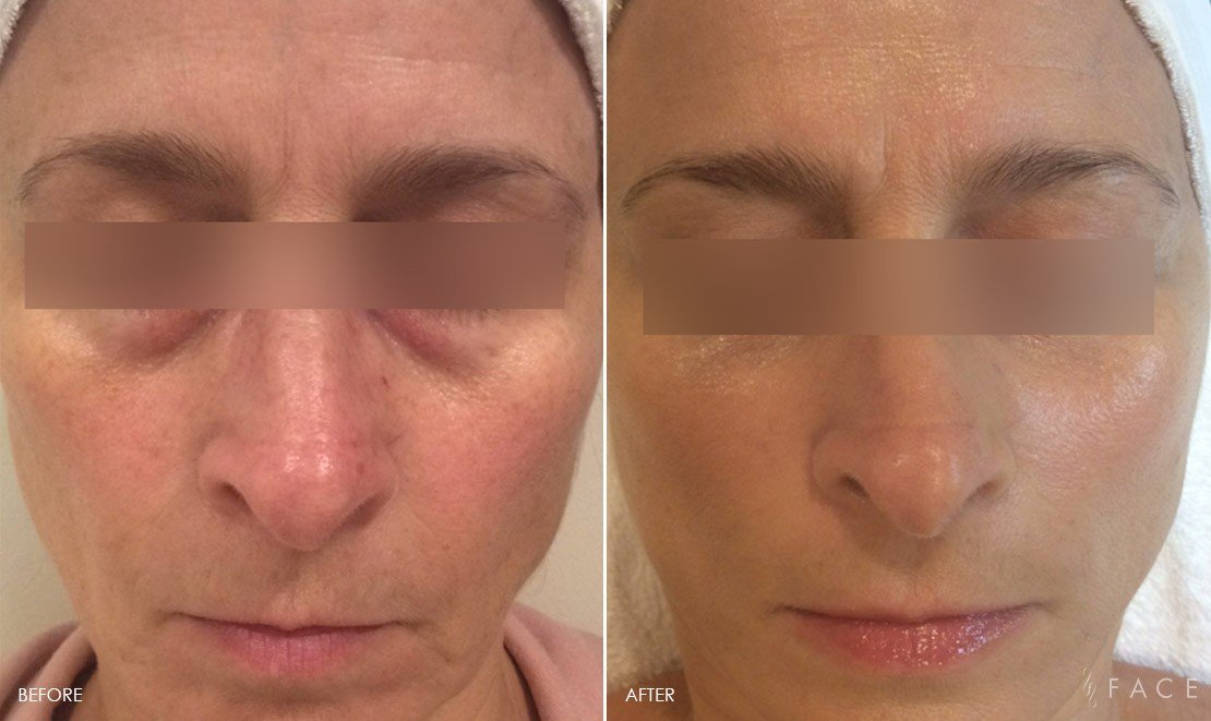 Anti-Aging Results Oakland County MI | FACE Beauty Science