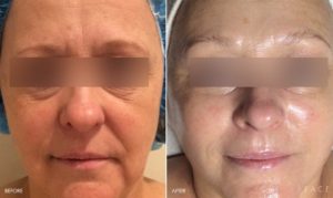 Anti-Aging Results Oakland County MI | FACE Beauty Science