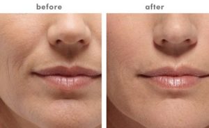 BELOTERO BALANCE® in Oakland County MI | FACE Beauty Science