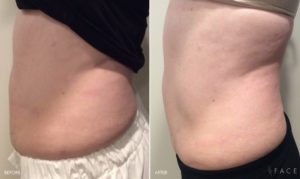 Body Makeover Detroit