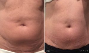 Body Makeover Oakland County MI | FACE Beauty Science