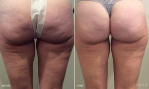 Body Makeover Detroit