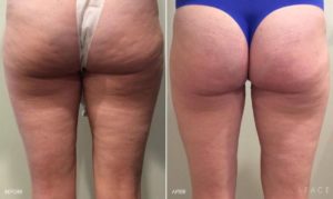 Body Makeover Detroit