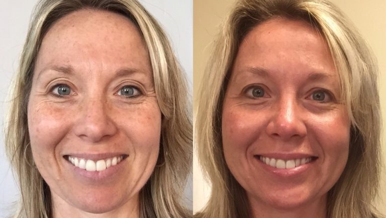 Medical Peels & Chemical Peels in Oakland County MI | FACE Beauty Science