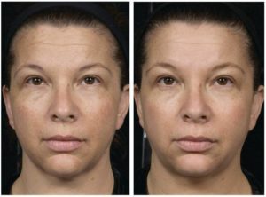 Clear + Brilliant® Treatments in Oakland County MI | FACE Beauty Science