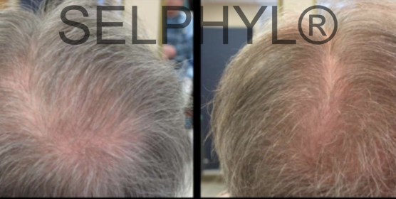 Selphyl PRFM and PRP Hair Restoration | Face Beauty Science