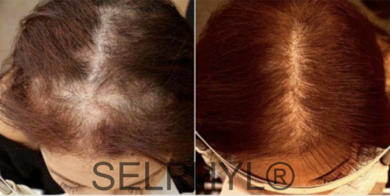 Selphyl PRFM and PRP Hair Restoration | Face Beauty Science
