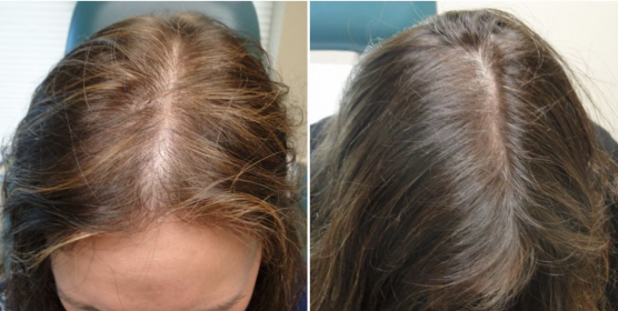 Selphyl PRFM and PRP Hair Restoration Treatments in Oakland County MI | FACE Beauty Science