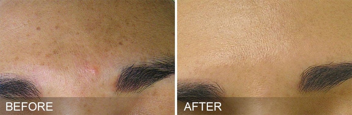 HydraFacial® Treatments in Oakland County MI | FACE Beauty Science