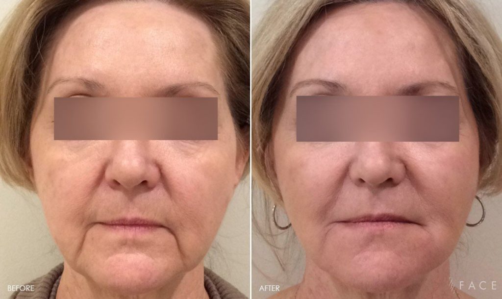 Face Photo Gallery - Injectables | Face Beauty Science