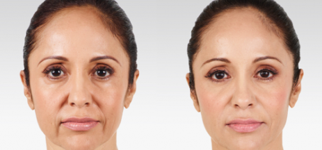 JUVÉDERM® Injectable Filler in Oakland County MI | FACE Beauty Science