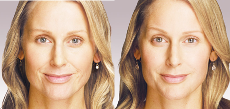 JUVÉDERM® Injectable Filler in Oakland County MI | FACE Beauty Science