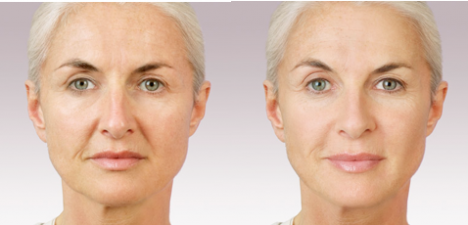 JUVÉDERM® Injectable Filler in Oakland County MI | FACE Beauty Science