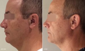 Kybella Detroit