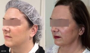 Kybella Detroit