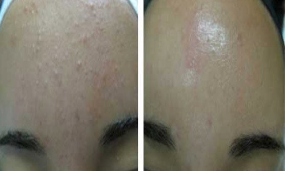 Lamprobe Treatments in Oakland County MI | FACE Beauty Science